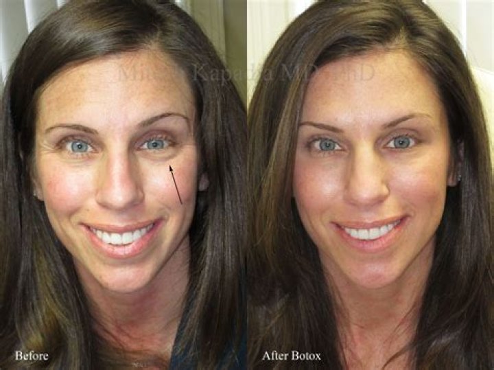 Amy Poehler Plastic Surgery Before and After Botox Injections |