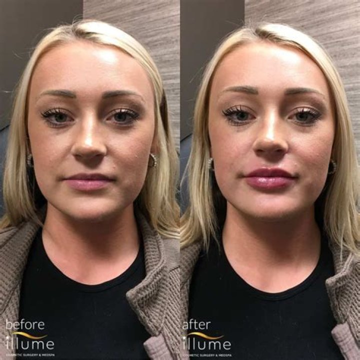 Did Gwen Stefani Get Lips Surgery? Before And After Photos